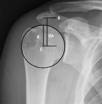 Relevance between Proximal Humeral Migration and Rotator Cuff Tears